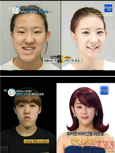 韓国で多いエラ手術は美容整形にカウントされていない可能性