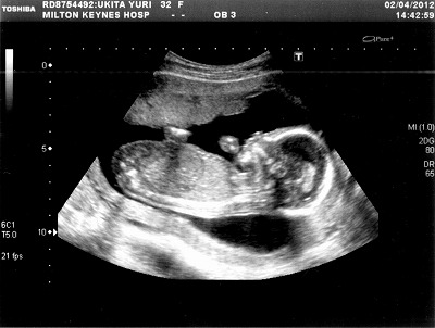 妊娠18週目 臨時検診 超音波 初の内診 性別発覚 英国こしかけ日記